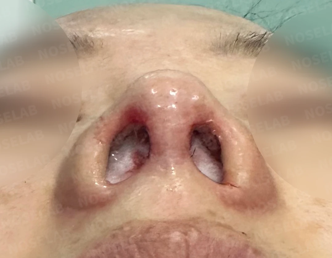 작고 뭉툭한 코의 교정 방법 — 수술 직후 0일 콧구멍 사진 직후 사진은 부기가 있는 상태로 최종 결과와 다를 수 있습니다.