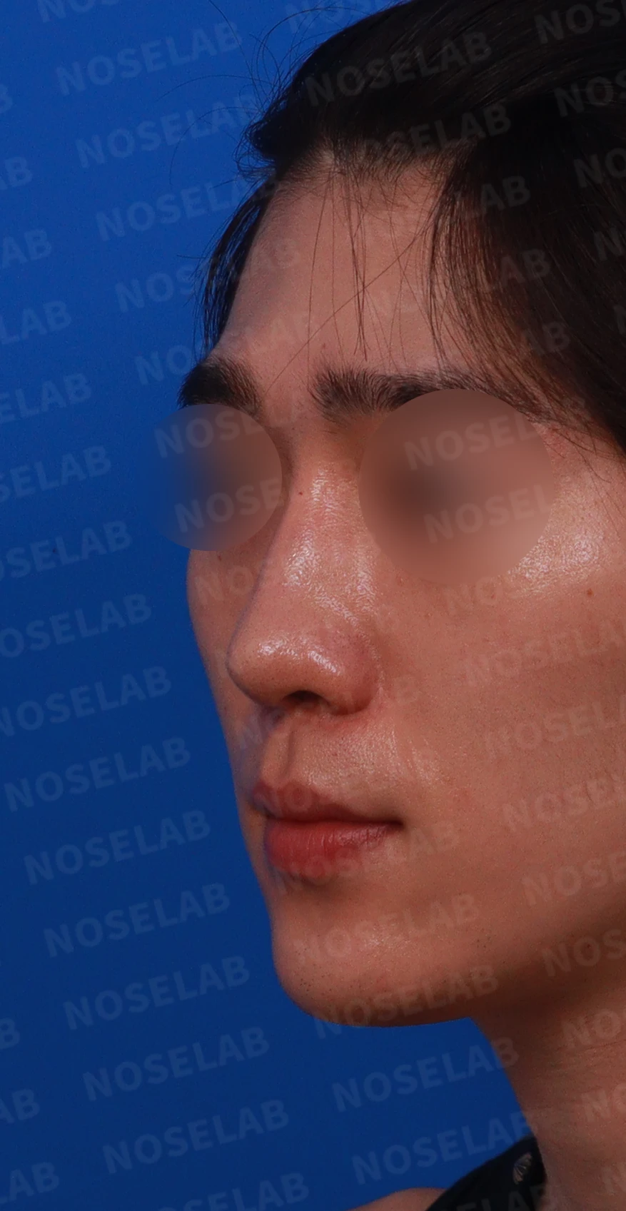 코골절과 반복 재수술 뒤 남는 흉터 조직과 비공 비대칭, 재건 방법 — 디자인 상담 정면 , 좌측 비스듬한 측면 , 측면 사진입니다.