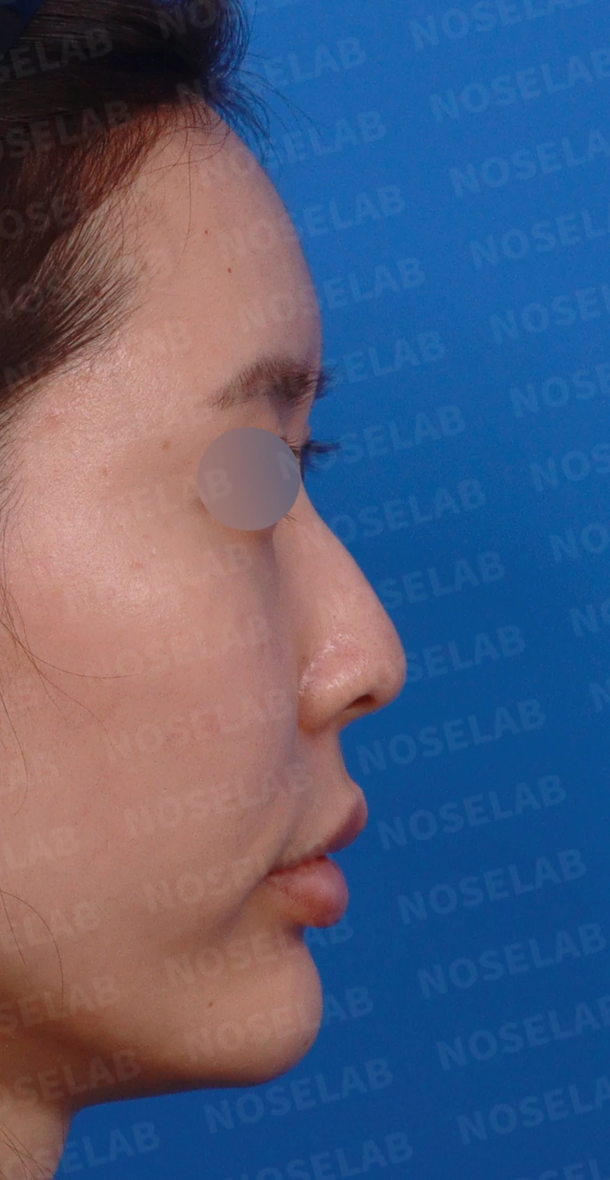 작고 처진 코와 코막힘이 함께 있을 때의 교정 방법 — 디자인 상담 우측 측면, 비스듬한 측면, 비공 사진입니다