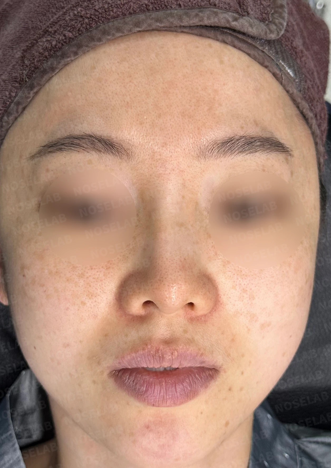 작고 뭉툭한 코의 교정 방법 — 수술 전 / 수술 직후 0일 직후 사진은 부기가 있는 상태로 최종 결과와 다를 수 있습니다.