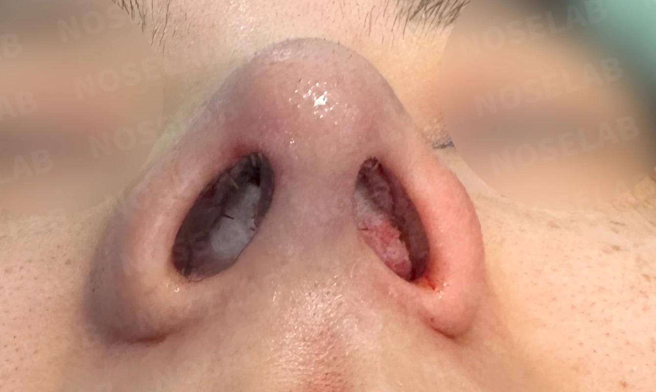 복코, 퍼진코 교정 방법 — 수술 전 / 수술 직후 0일 직후 사진은 부기가 있는 상태로 최종 결과와 다를 수 있습니다.