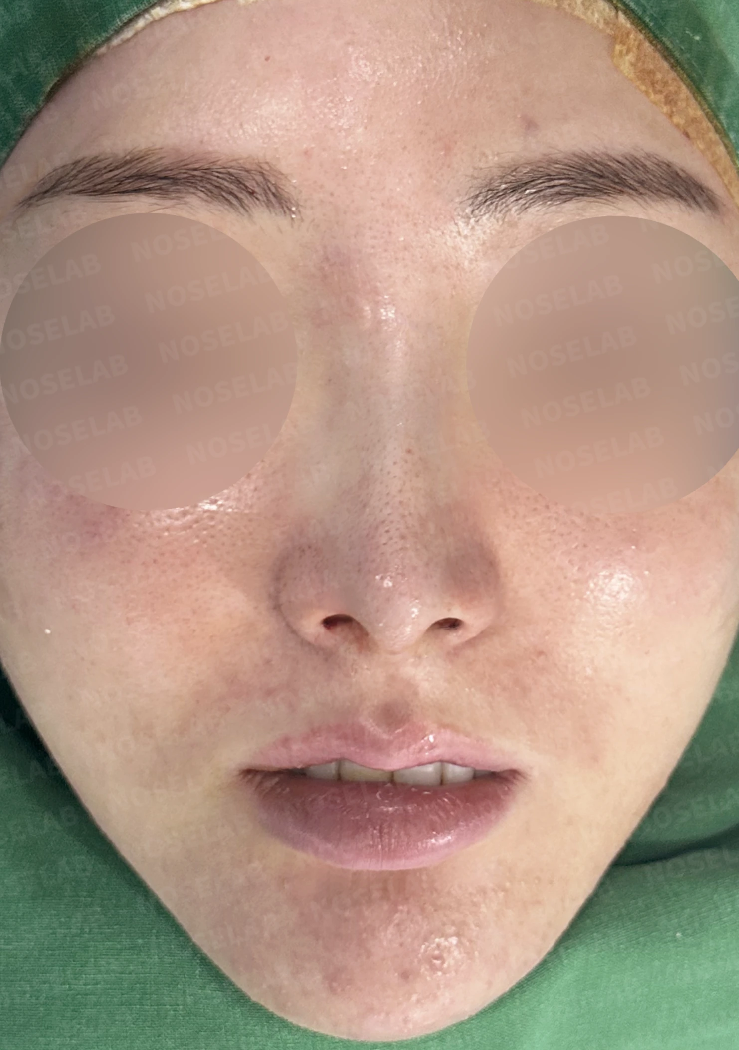 코가 길어 보이고 비주가 휘는 이유, 비중격 연장과 재건은 어떻게 하나 — 수술 직후 0일 정면, 비스듬한 측면, 측면 사진 직후 사진은 부기가 있는 상태로 최종 결과와 다를 수 있습니다.