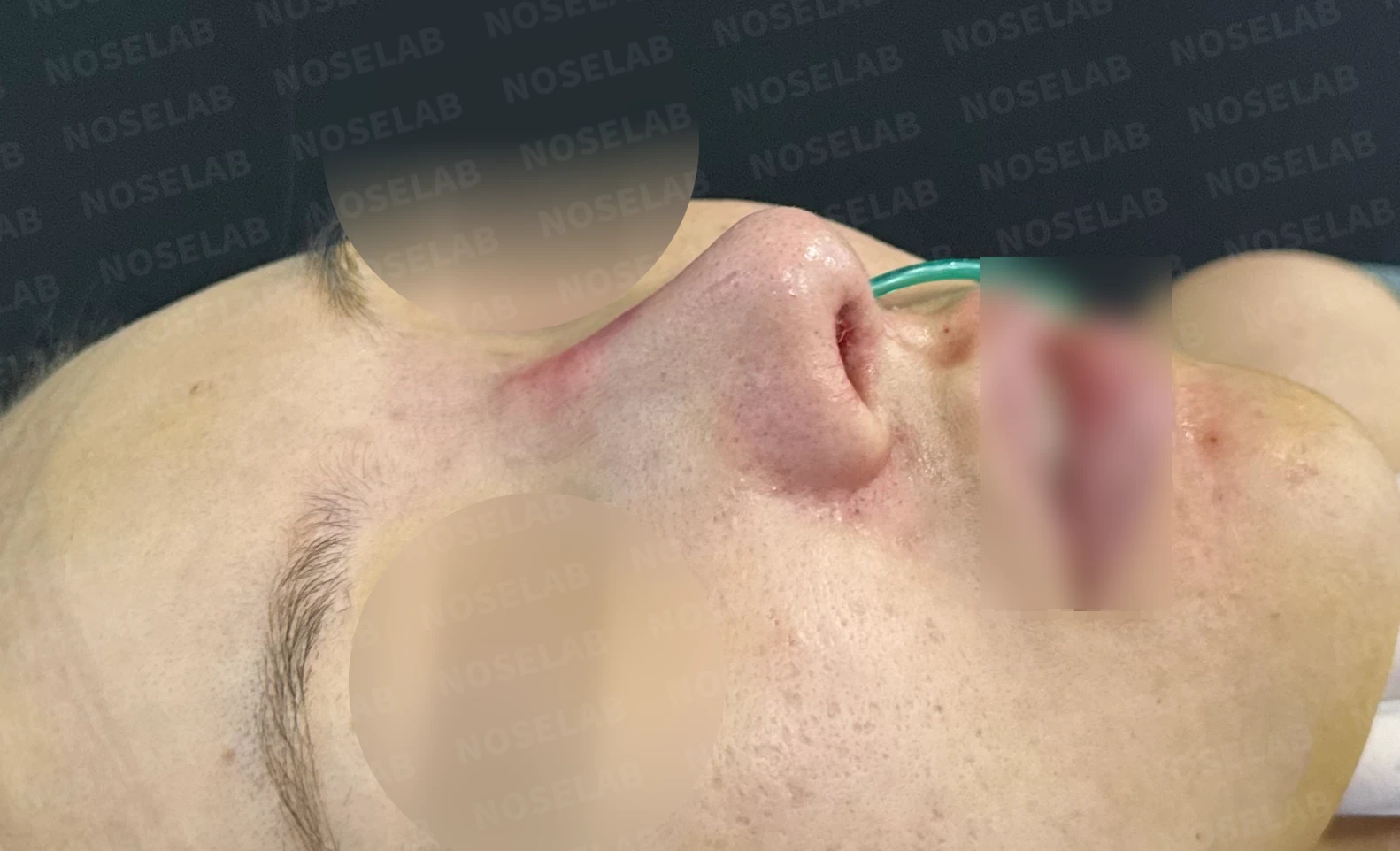 반복 수술 후 긴 코와 높은 시작점의 재수술 방법 — 수술 전 / 수술 직후 0일 직후 사진은 부기가 있는 상태로 최종 결과와 다를 수 있습니다.
