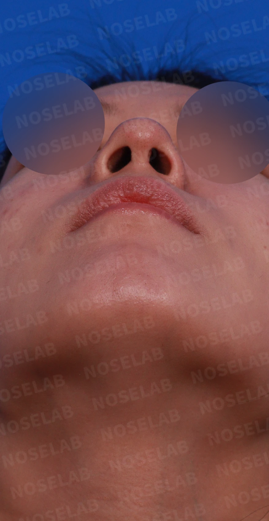 재수술 뒤에도 복코와 퍼진 코끝이 남는 이유, 자가 늑연골 재건은 어떻게 하나 — 디자인 상담 우측 비스듬한 측면, 측면, 비공 사진입니다.