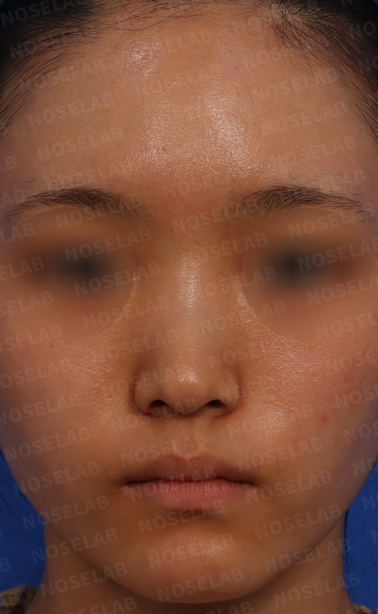 긴코·퍼진코 교정 방법 — 본문 사진 1