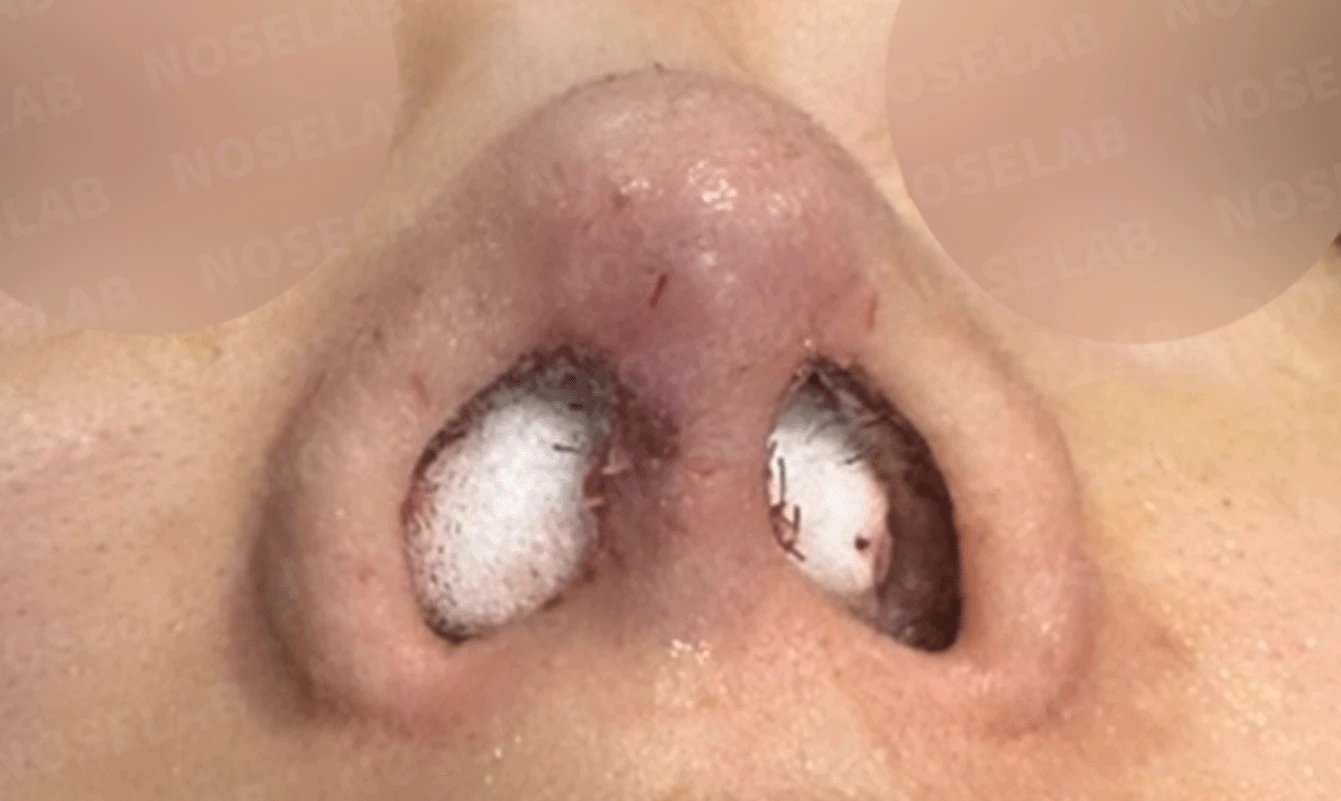실리콘 보형물이 코끝 피부를 뚫고 나오려 할 때, 왜 생기고 어떻게 재건하나 — 본문 사진 20