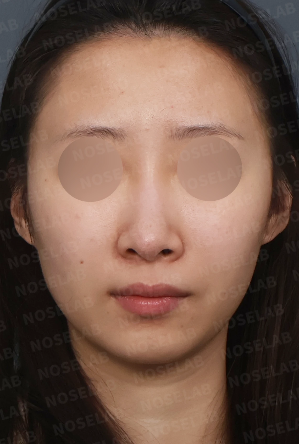 길고 처진 코, 휜코 교정과 코막힘까지 한 번에 해결한 재수술 사례 — 디자인 상담 정면, 좌측 측면, 비스듬한 측면 사진입니다.