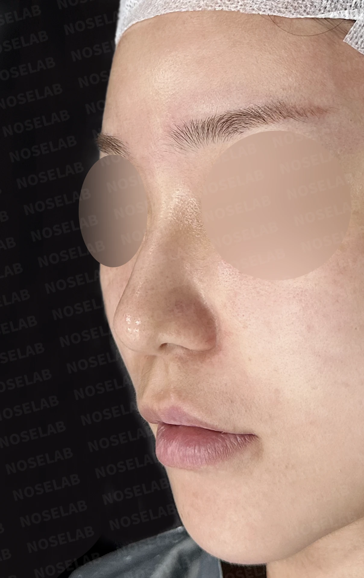 복코가 뭉툭하고 퍼져 보이는 이유와 코끝 입체감을 만드는 방법 — 수술 전 / 수술 직후 0일 직후 사진은 부기가 있는 상태로 최종 결과와 다를 수 있습니다.