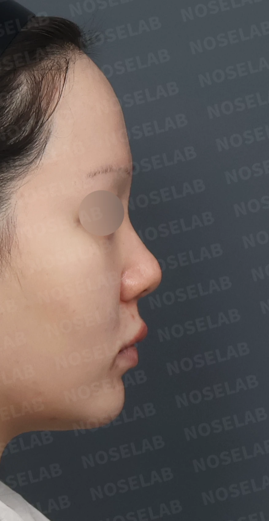 복코와 들린 코끝, 자가늑연골로 여성스러운 직반라인 완성 — 디자인 상담 우측 측면, 비스듬한 측면, 비공 사진입니다.