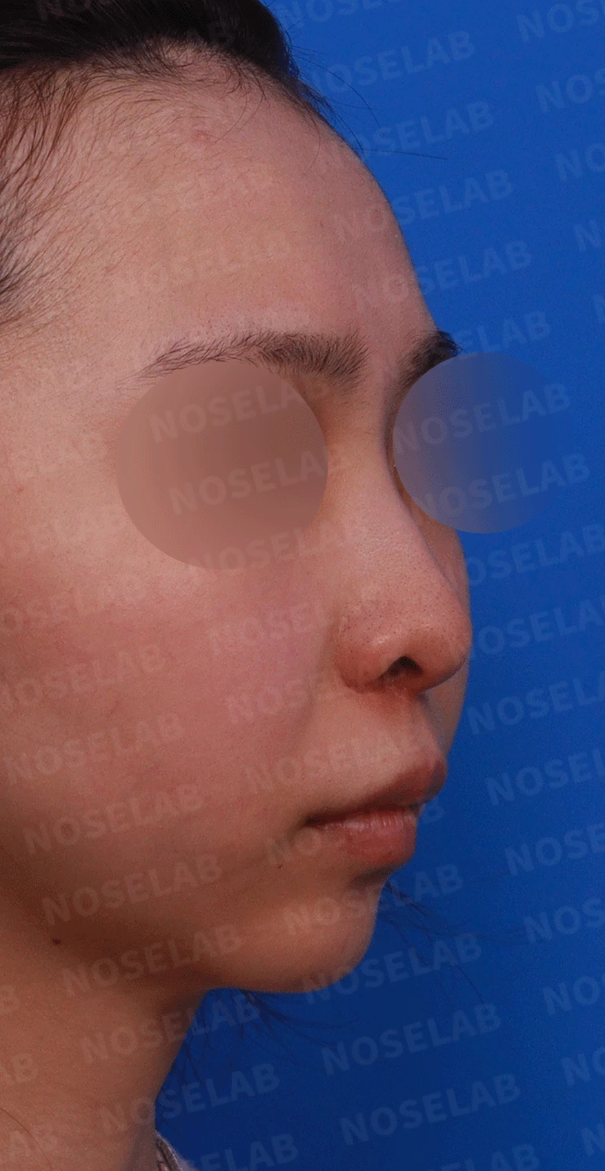 여러 번 수술해도 콧대가 낮고 복코가 남는 이유, 늑연골 재건과 얼굴 균형 — 디자인 상담 우측 비스듬한 측면 , 측면 , 비공 사진입니다.