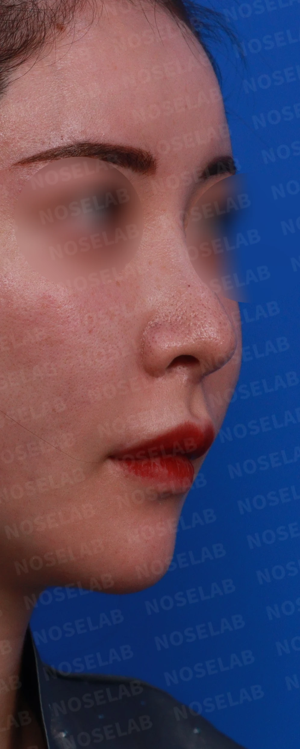코막힘, 콧구멍비대칭 교정 사례 — 수술전 디자인 콧구멍, 우측 비스듬한 측면, 측면