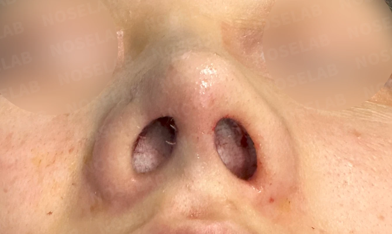 매부리코와 처진 코끝이 함께 있을 때, 콧대와 코끝의 균형 잡는 법 — 수술 직후 0일 비공 사진입니다. 직후 사진은 부기가 있는 상태로 최종 결과와 다를 수 있습니다.