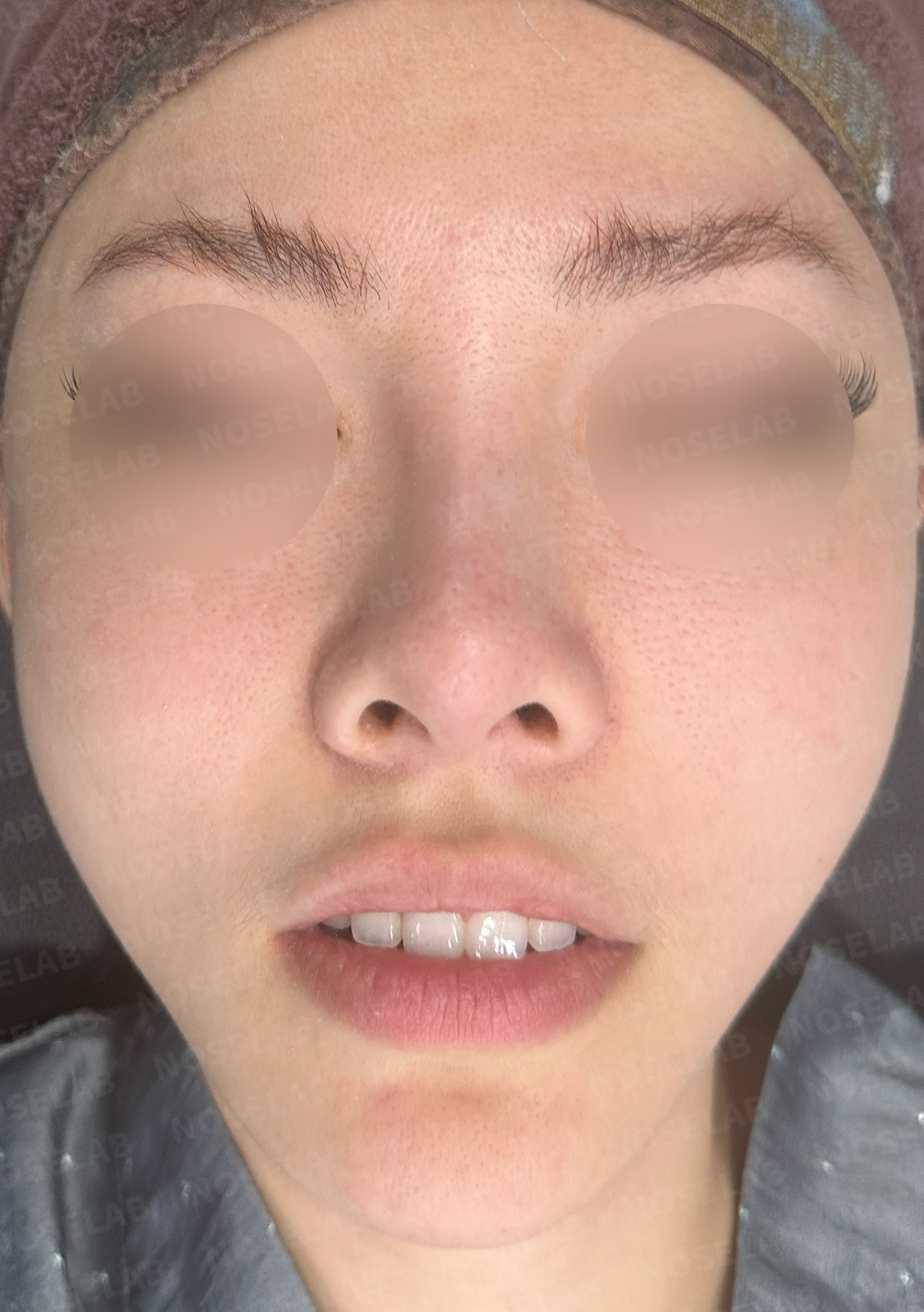 필러와 실 시술을 반복한 코에 미간이 퍼지고 코끝이 들리는 이유 — 수술 전 / 수술 직후 0일 직후 사진은 부기가 있는 상태로 최종 결과와 다를 수 있습니다.