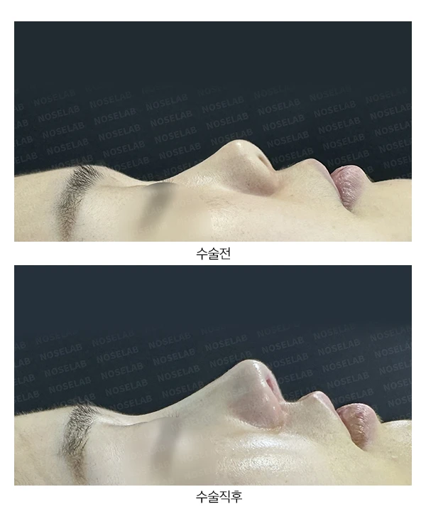 작고 짧은 들린 코 교정 방법 — 전후 비교