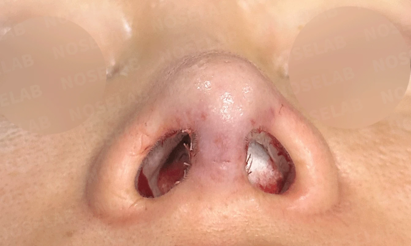 후비루와 코끝 처짐이 함께 나타나는 이유, 비중격 연장과 기능 수술은 어떻게 하나 — 본문 사진 14