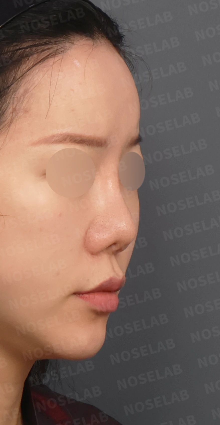 짧은 코와 복코, 자가늑연골로 세련되게 교정한 코재수술 — 디자인 상담 우측 측면, 비스듬한 측면, 비공 사진입니다.