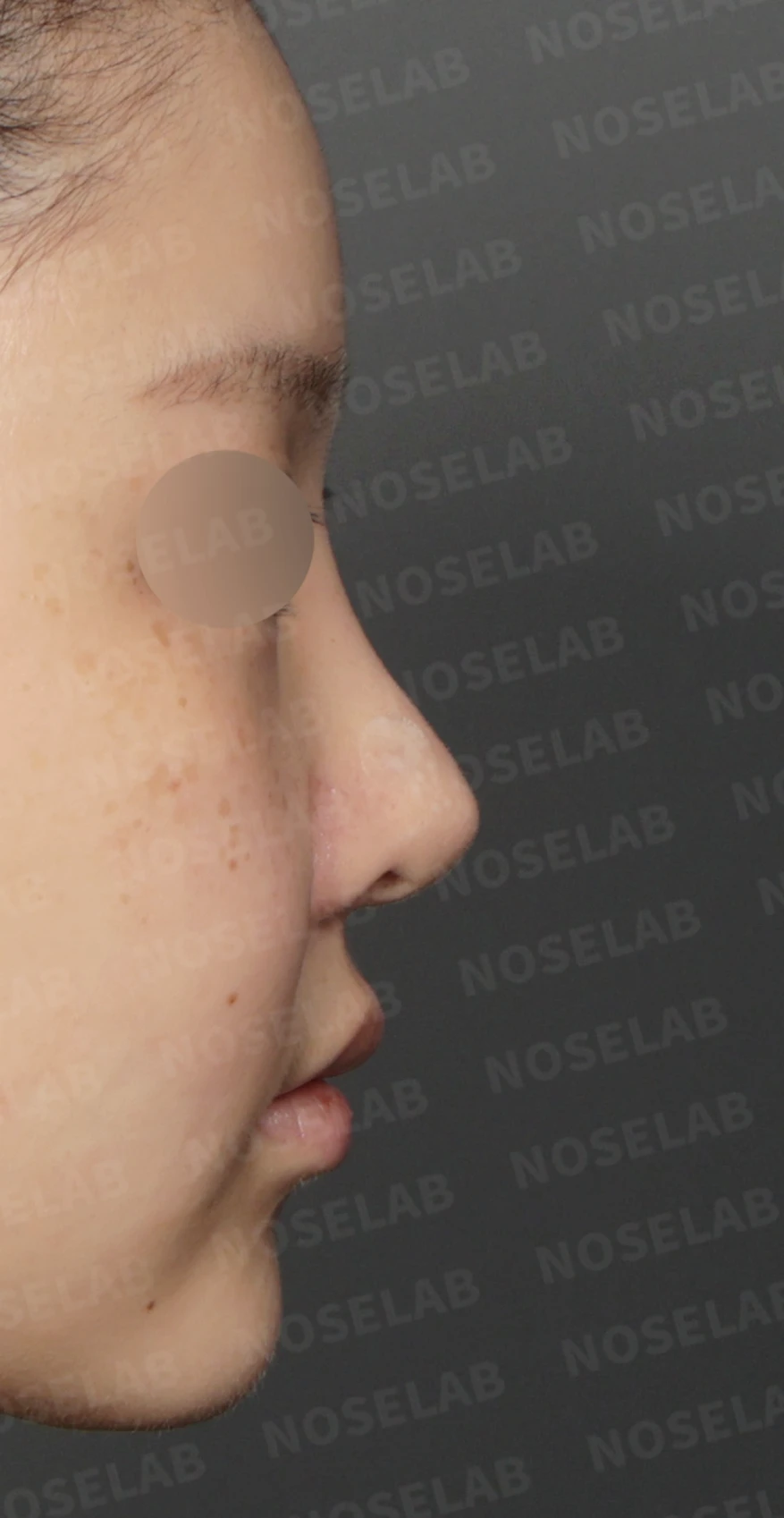 휘어진 코와 복코, 자가늑연골 비중격 재건으로 안전하게 교정한 코재수술 — 디자인 상담 우측 측면, 비스듬한 측면, 비공 사진입니다.