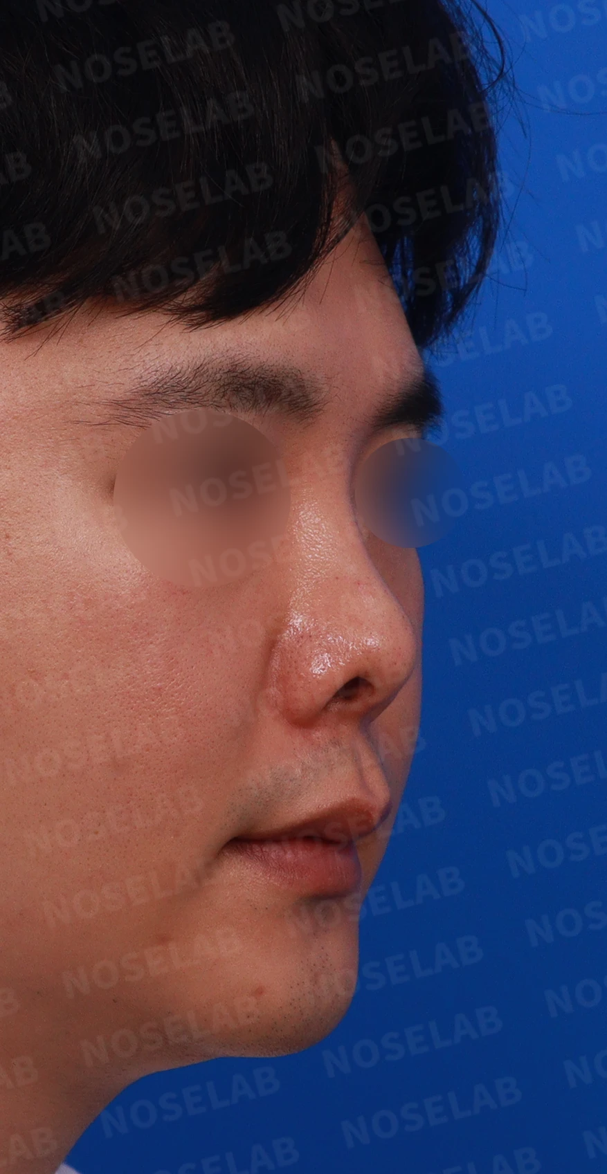 비중격 연골을 많이 쓴 코가 들리고 막히는 이유, 재건은 어떻게 하나 — 디자인 상담 우측 측면 , 비스듬한 측면 , 비공 사진입니다.