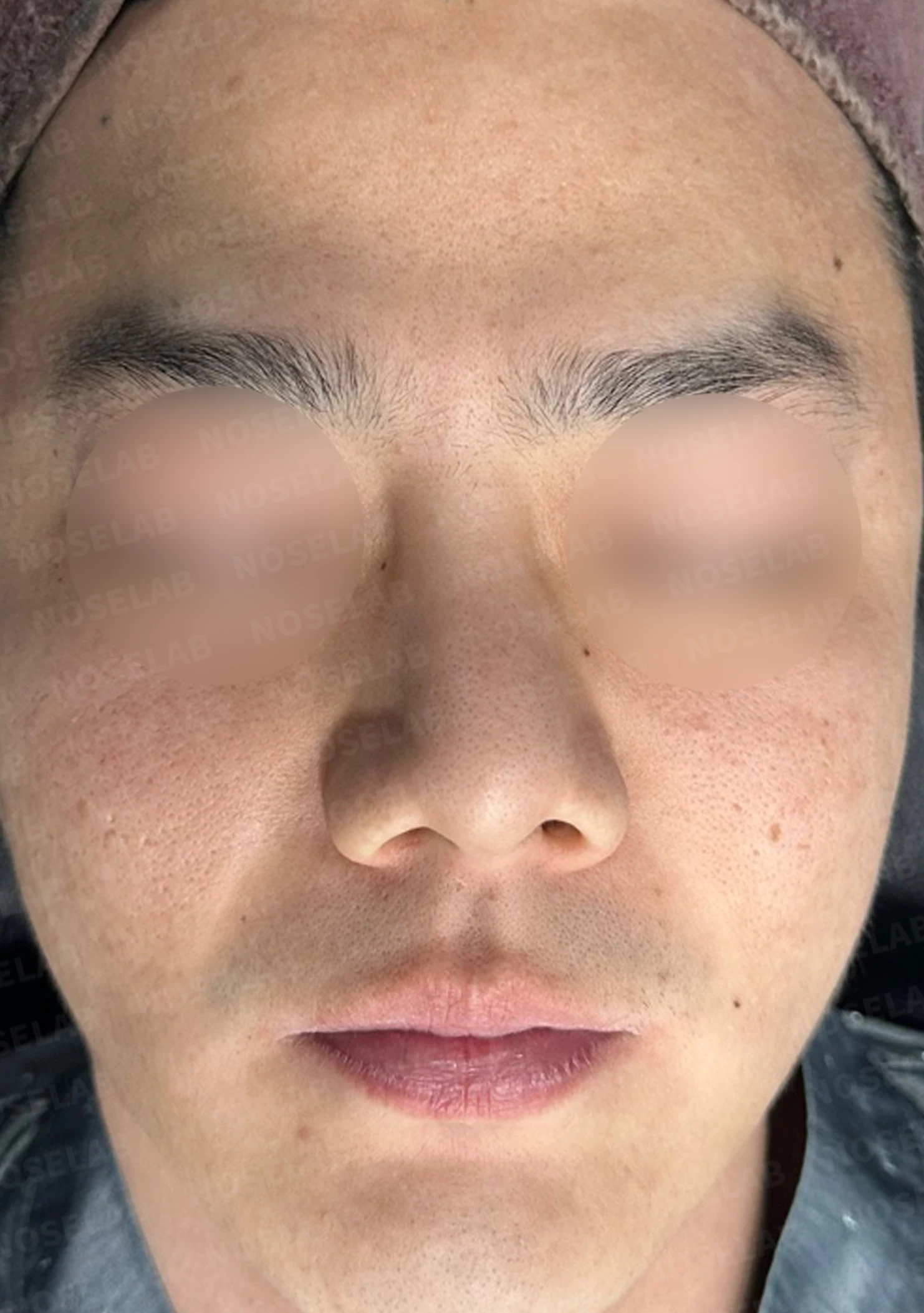 콧구멍 비대칭과 들린 코가 함께 생기는 이유, 늑연골 재건은 어떻게 하나 — 수술 전 / 수술 직후 0일 직후 사진은 부기가 있는 상태로 최종 결과와 다를 수 있습니다.