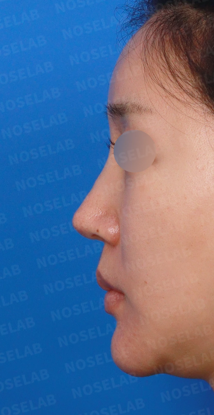 영구 필러가 코 모양을 바꾸는 과정과 제거 후 재건 방법 — 디자인 상담 정면, 좌측 측면, 비스듬한 측면 사진입니다.