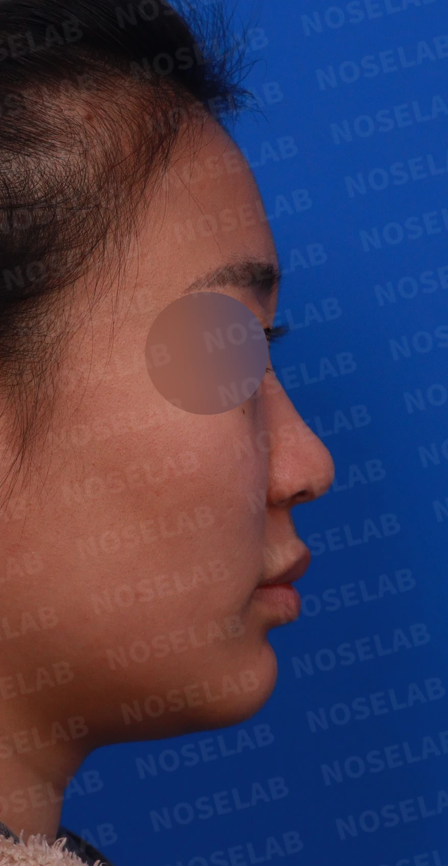 뭉툭하게 퍼진 코끝이 생기는 이유, 자가 늑연골 비중격 연장으로 직반 라인을 만드는 방법 — 디자인 상담 우측 측면, 비스듬한 측면, 비공 사진