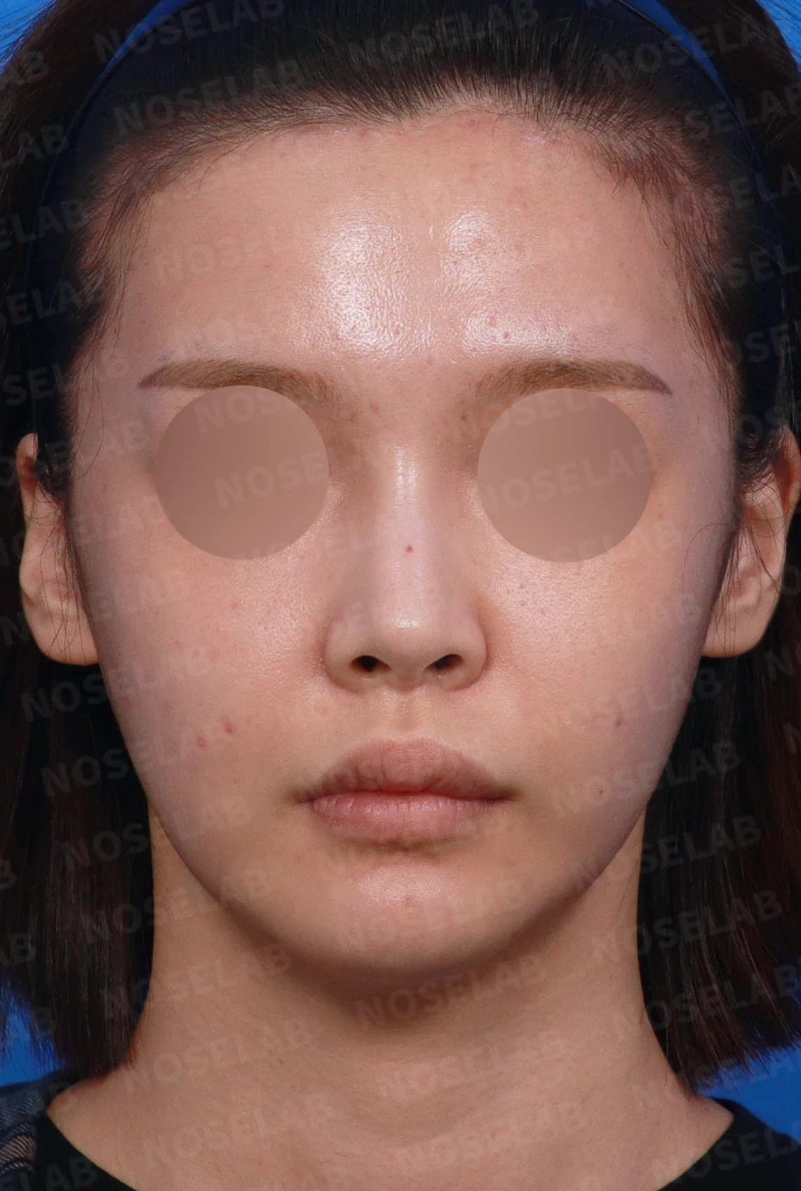 코 시작점이 높고 코끝이 들려 보이는 이유와 교정 방법 — 디자인 상담 정면, 좌측 측면, 비스듬한 측면 사진입니다.