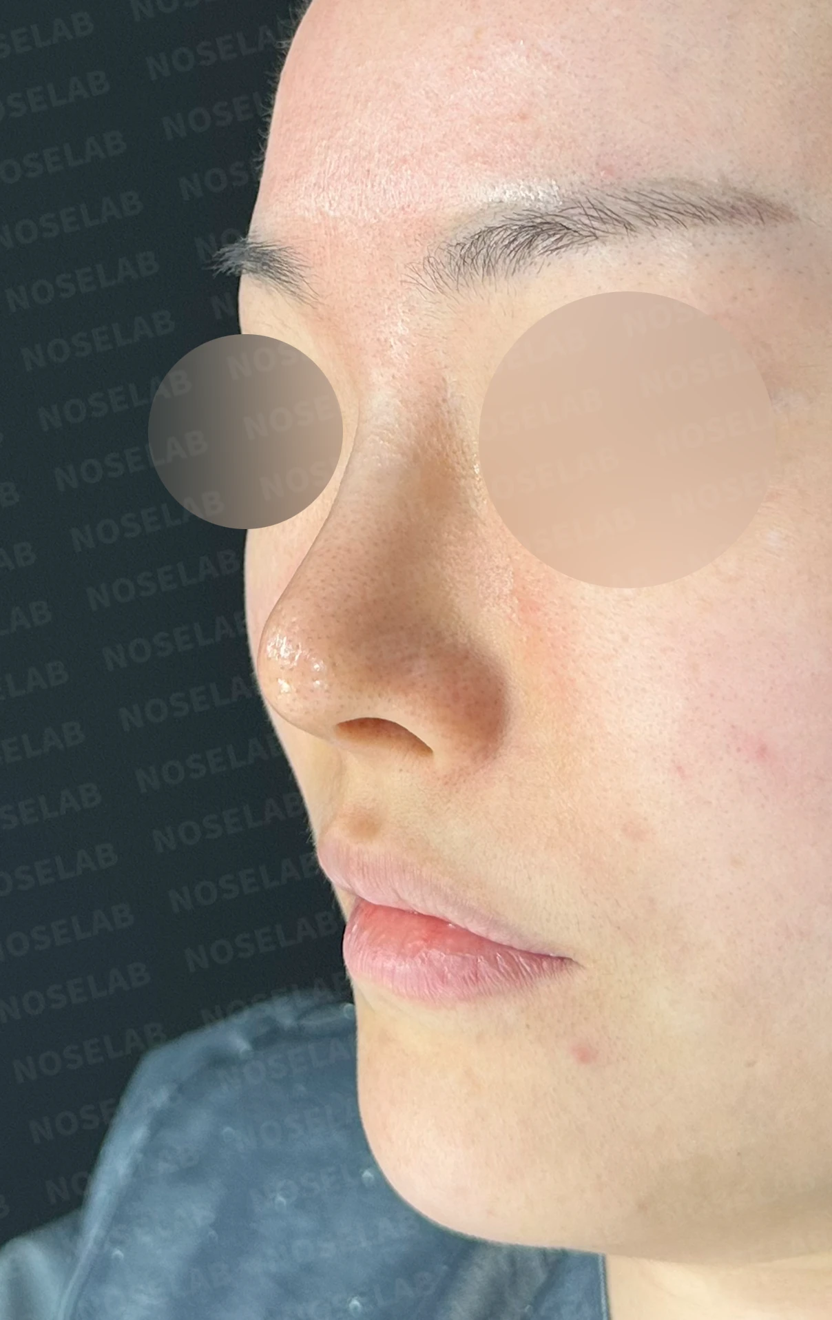 코끝이 비치는 이유와 코끝 포인트를 낮추는 교정 방법 — 본문 사진 14