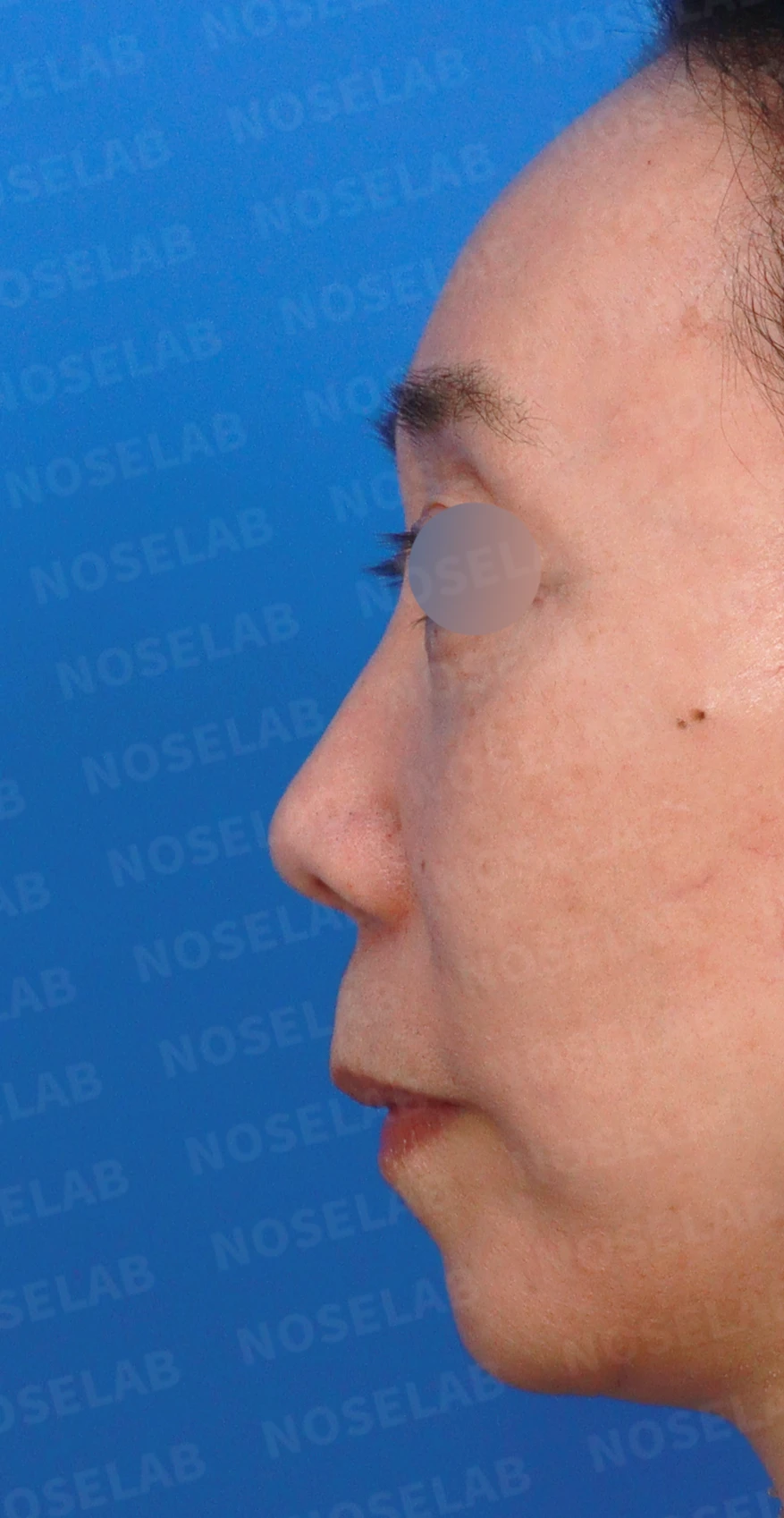 정면에서 콧구멍이 한쪽만 더 보이는 이유와 코끝 재건 방법 — 디자인 상담 정면, 좌측 측면, 비스듬한 측면 사진입니다.