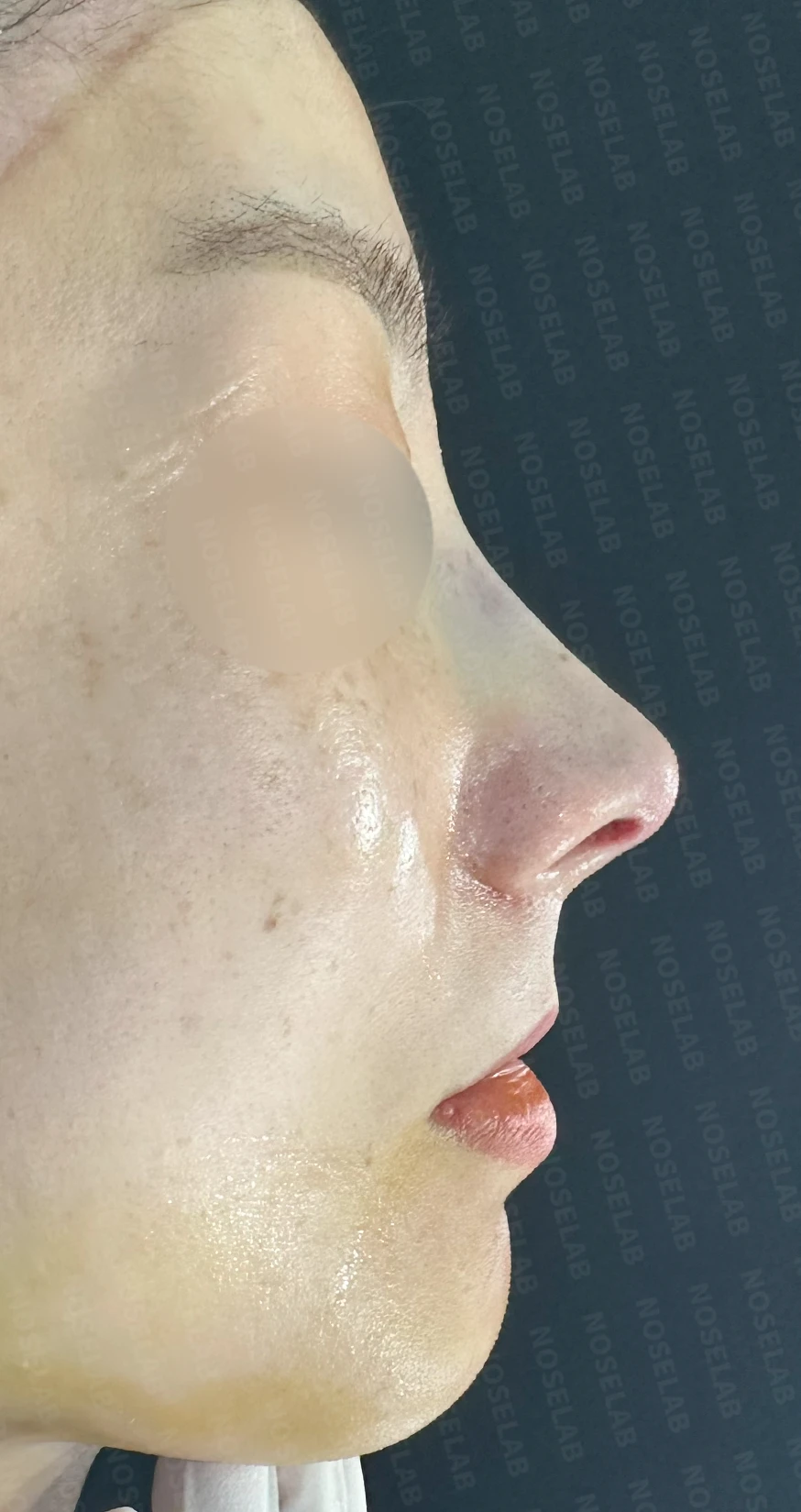 복코, 퍼진코 교정 방법 — 수술 직후 0일 정면, 측면, 비스듬한 측면 사진 직후 사진은 부기가 있는 상태로 최종 결과와 다를 수 있습니다.