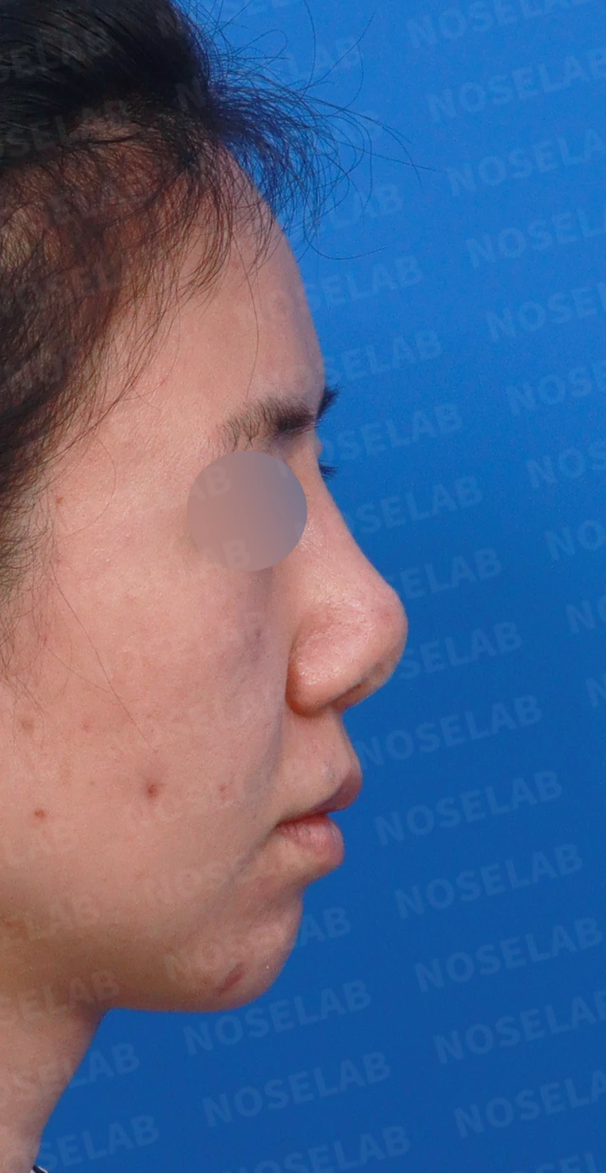 이전 수술 뒤 코가 딱딱해지고 짧아지는 구축, 왜 생기고 어떻게 재건하나 — 디자인 상담 우측 측면, 비스듬한 측면, 비공 사진입니다.