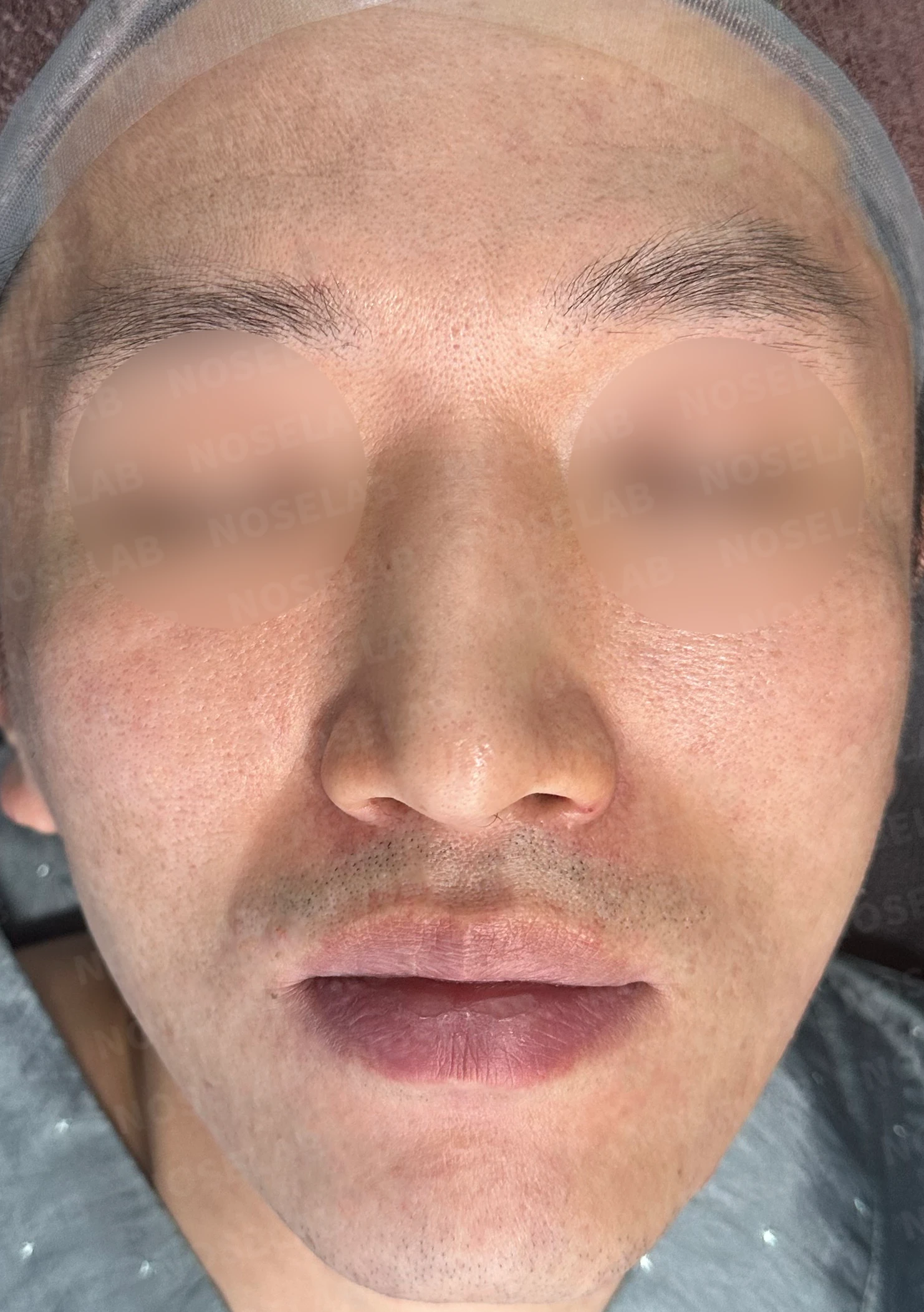 매부리코·휜코 교정 방법 — 수술 전 / 수술 직후 0일 직후 사진은 부기가 있는 상태로 최종 결과와 다를 수 있습니다.