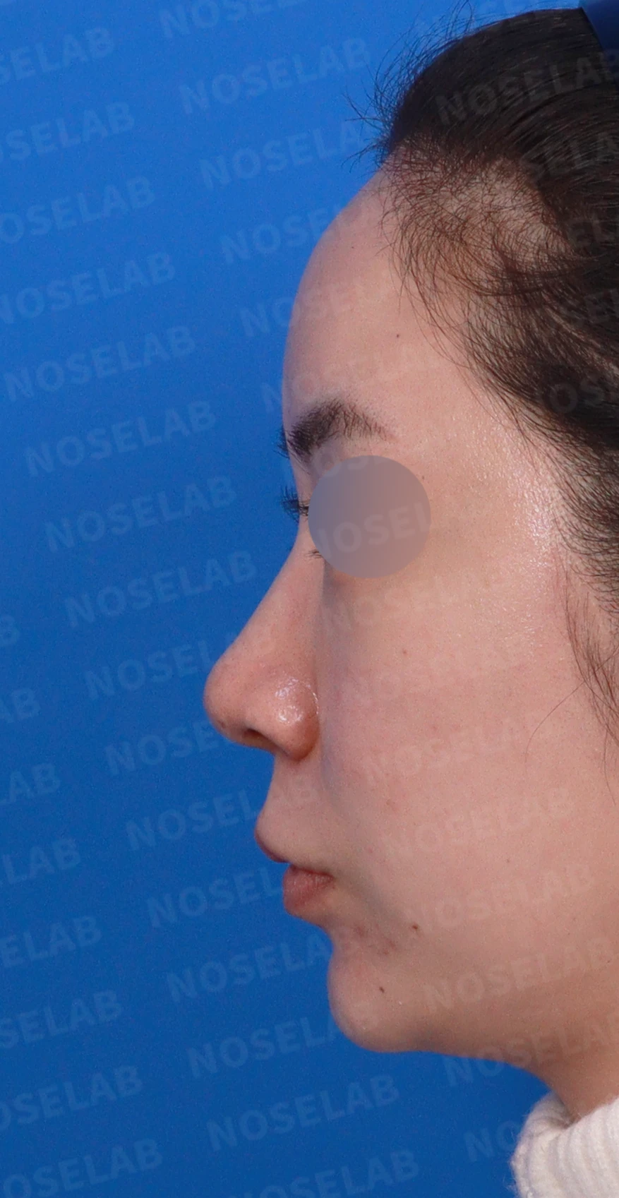 코끝이 퍼져 보이는 이유와 코바닥·비순각을 함께 다루는 방법 — 디자인 상담 정면, 좌측 측면, 비스듬한 측면 사진입니다.