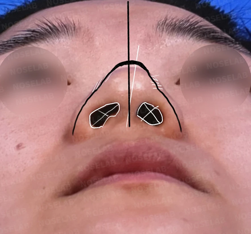 복코 수술은 어떻게 하나요? — 수술전 디자인 상담때 찍은 콧구멍 사진입니다.