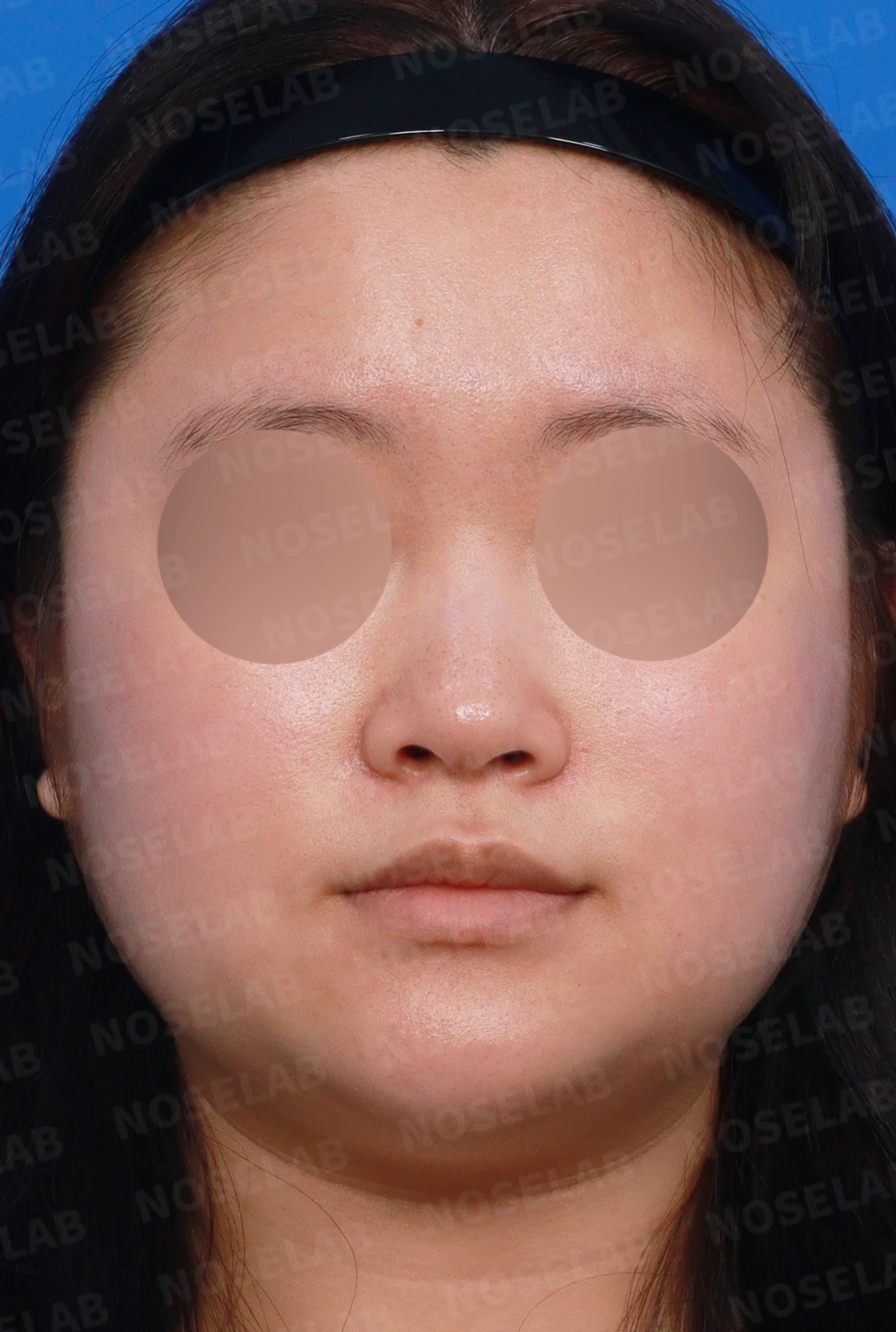 코가 퍼지고 코끝이 뭉툭해 보이는 이유, 비중격연골과 귀연골 교정은 어떻게 하나 — 디자인 상담 정면, 좌측 측면, 비스듬한 측면 사진입니다.