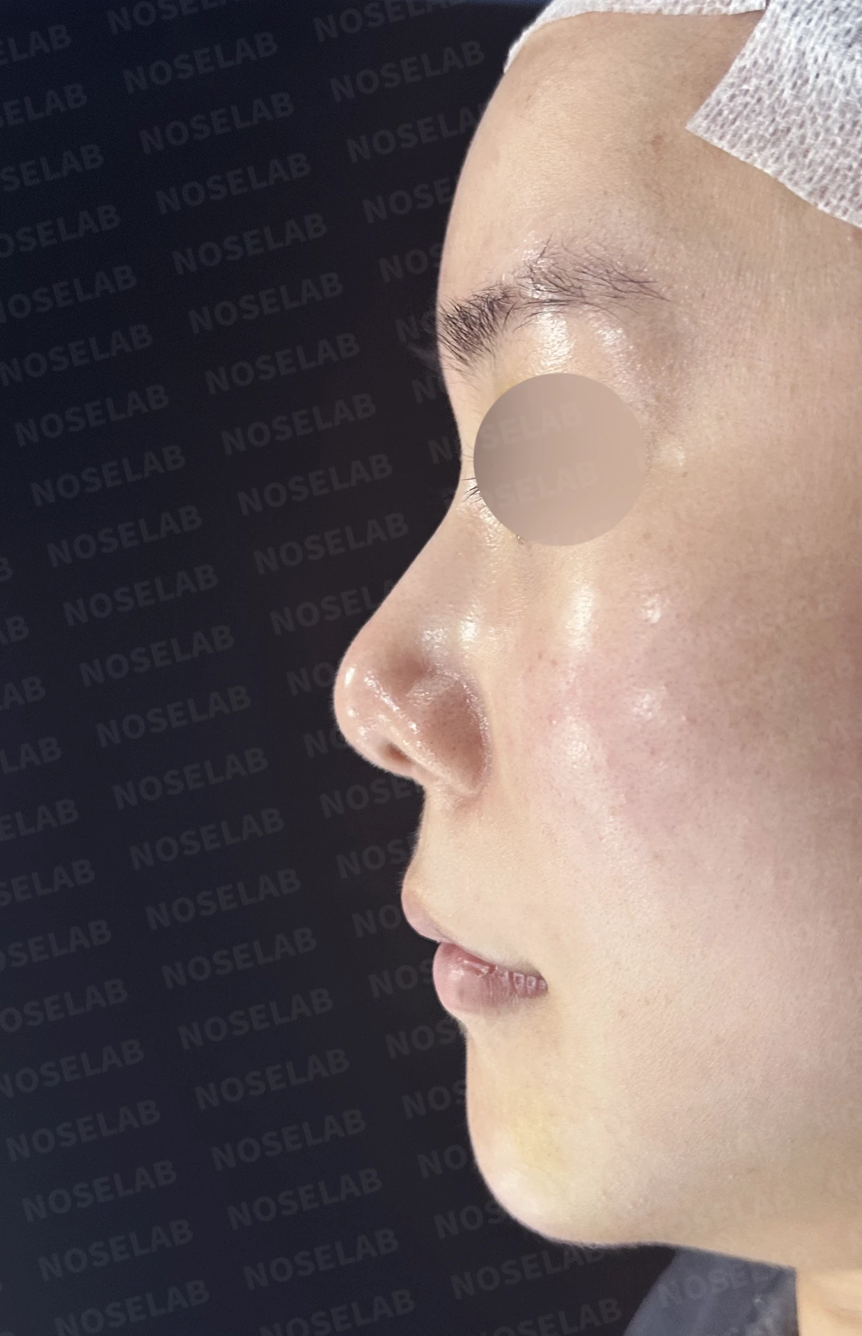 들린 코와 한쪽만 찝힌 콧구멍이 생기는 이유, 무보형물 재건은 어떻게 하나 — 수술 전 / 수술 직후 0일 직후 사진은 부기가 있는 상태로 최종 결과와 다를 수 있습니다.