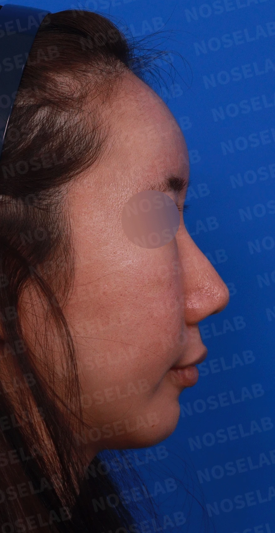 오래된 코 수술 뒤 비주가 함몰되고 코끝이 뭉툭해지는 이유와 재건 방법 — 디자인 상담 우측 비스듬한 측면, 측면, 비공 사진
