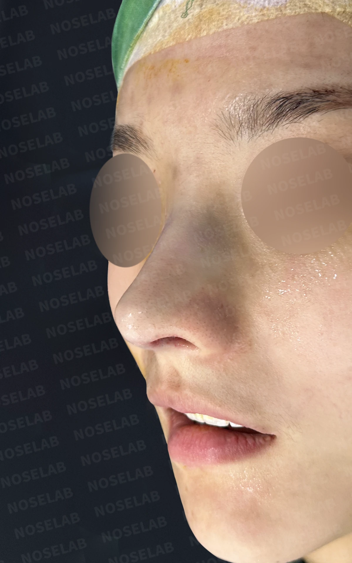 길고 처진 코끝과 코막힘, 자가늑연골로 자연스럽게 교정한 코재수술 — 수술 직후 정면 / 비스듬한 측면 / 측면