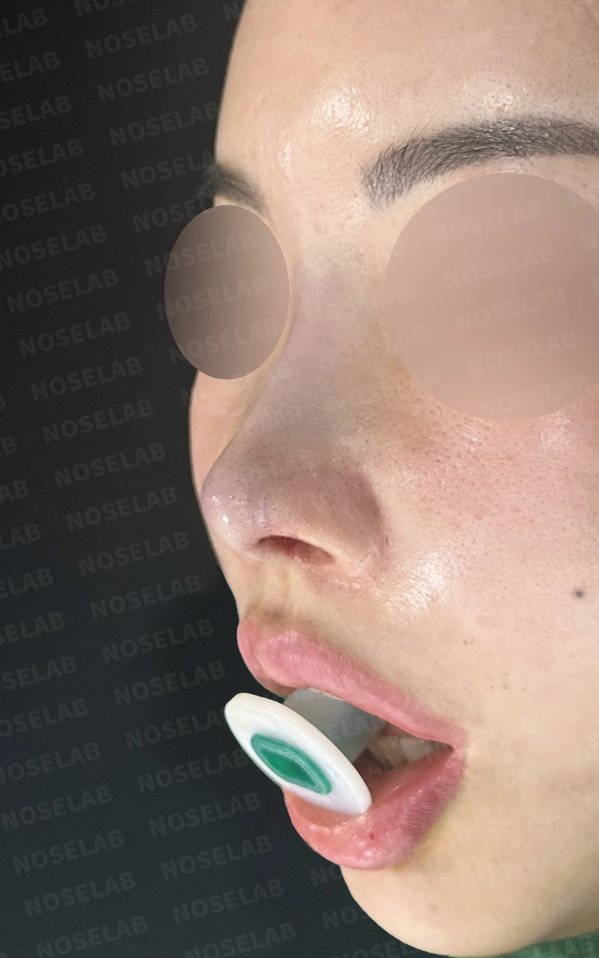 여러 차례 코 수술 뒤 내부 구조가 무너지는 이유와 늑연골 전체 재건 — 수술 전 / 수술 직후 0일 직후 사진은 부기가 있는 상태로 최종 결과와 다를 수 있습니다.
