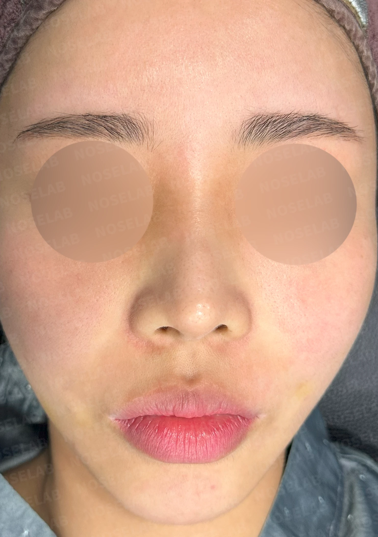 적절하지 않은 L자 실리콘 개선 - 안전한 구조로 재건 후기 — 전(좌) 직후(우)