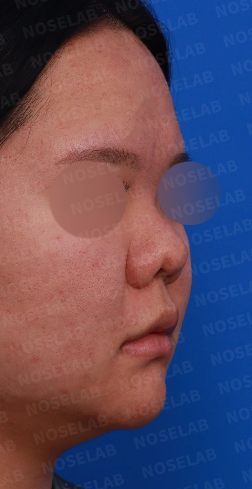 복코와 짧은 코, 비주 함몰이 함께 나타나는 이유와 코끝 입체감을 만드는 방법 — 디자인 상담 우측 비스듬한 측면, 측면, 비공 사진