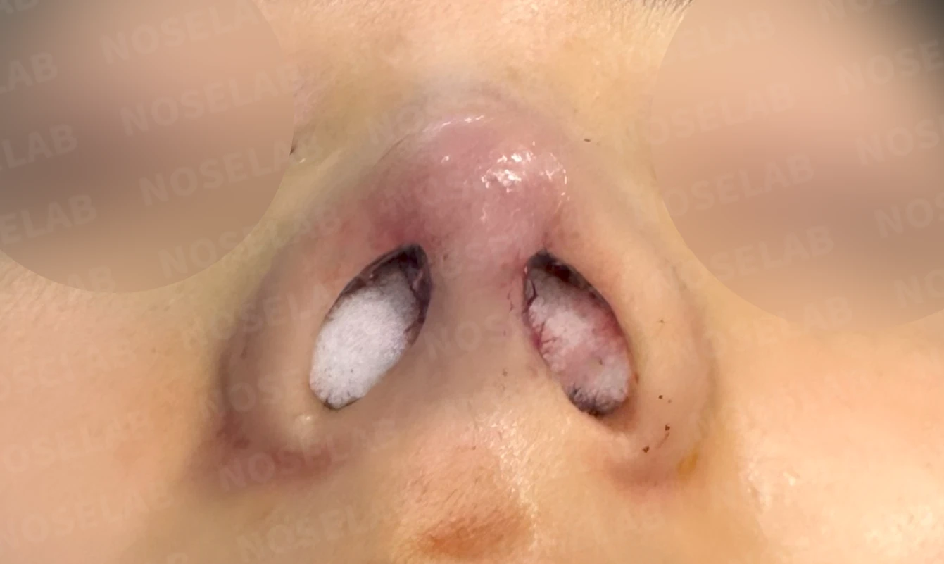 매부리코와 긴 코에 코막힘이 겹치는 이유, 교정은 어떻게 하나 — 수술 전 / 수술 직후 0일 직후 사진은 부기가 있는 상태로 최종 결과와 다를 수 있습니다.