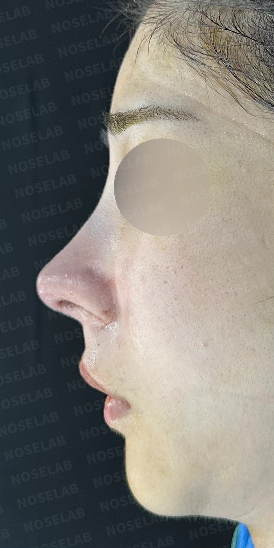 코가 뭉툭하고 퍼져 보이는 이유, 비순각과 비주는 어떻게 교정하나 — 수술 직후 0일 정면, 측면, 비스듬한 측면 사진 직후 사진은 부기가 있는 상태로 최종 결과와 다를 수 있습니다.