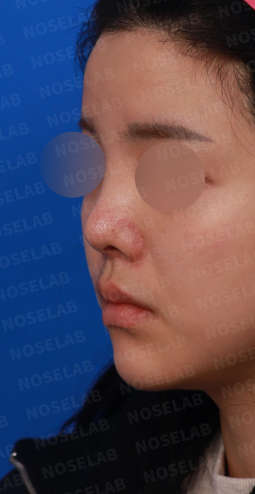 퍼진 콧대와 들린 코끝은 왜 생기나, 늑연골 재건은 어떻게 하나 — 디자인 상담 정면, 좌측 측면, 비스듬한 측면 사진