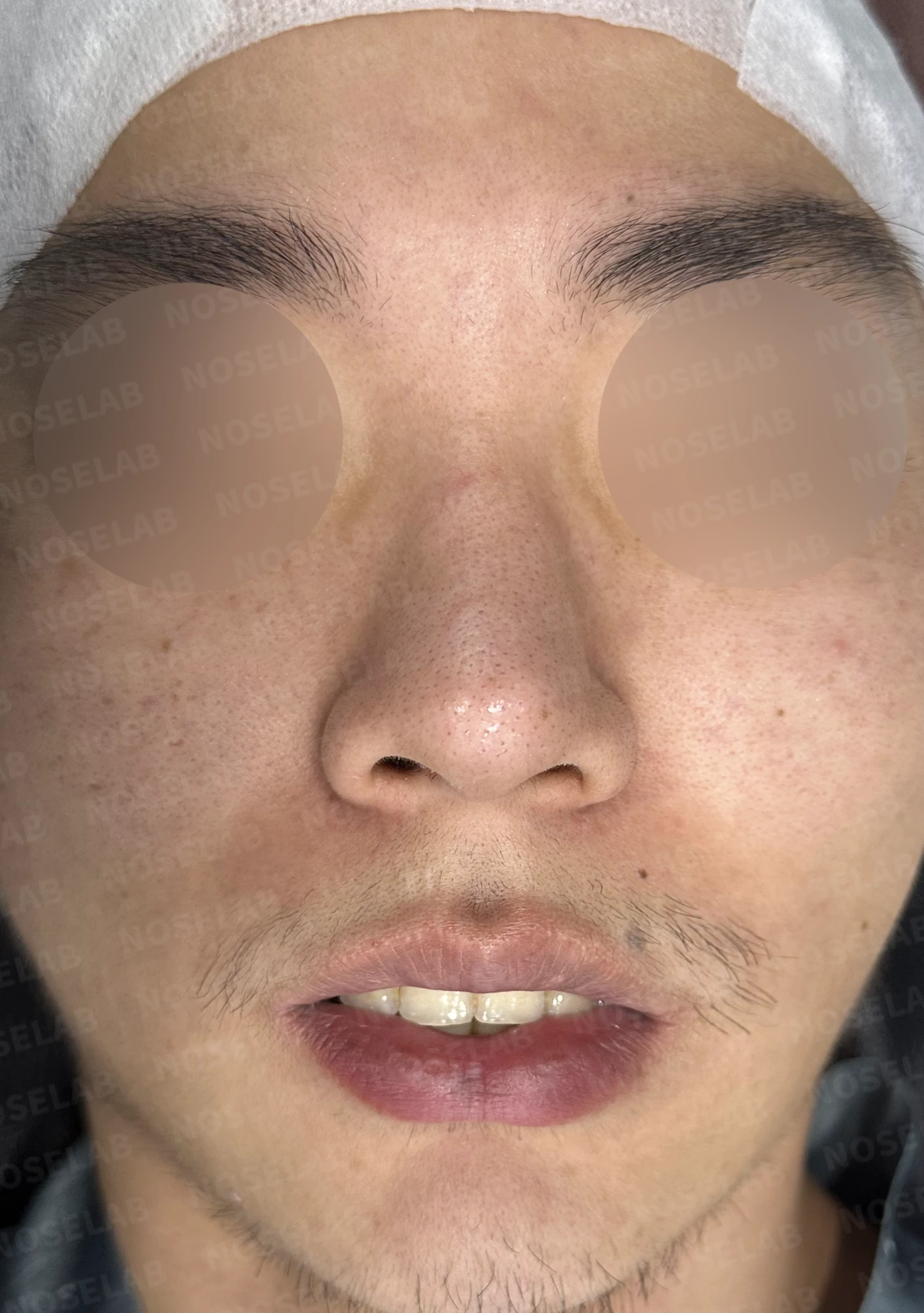 짧고 들린 코, 자가늑연골로 남성적인 라인으로 완성한 코재수술 — 전(좌) 직후(후)