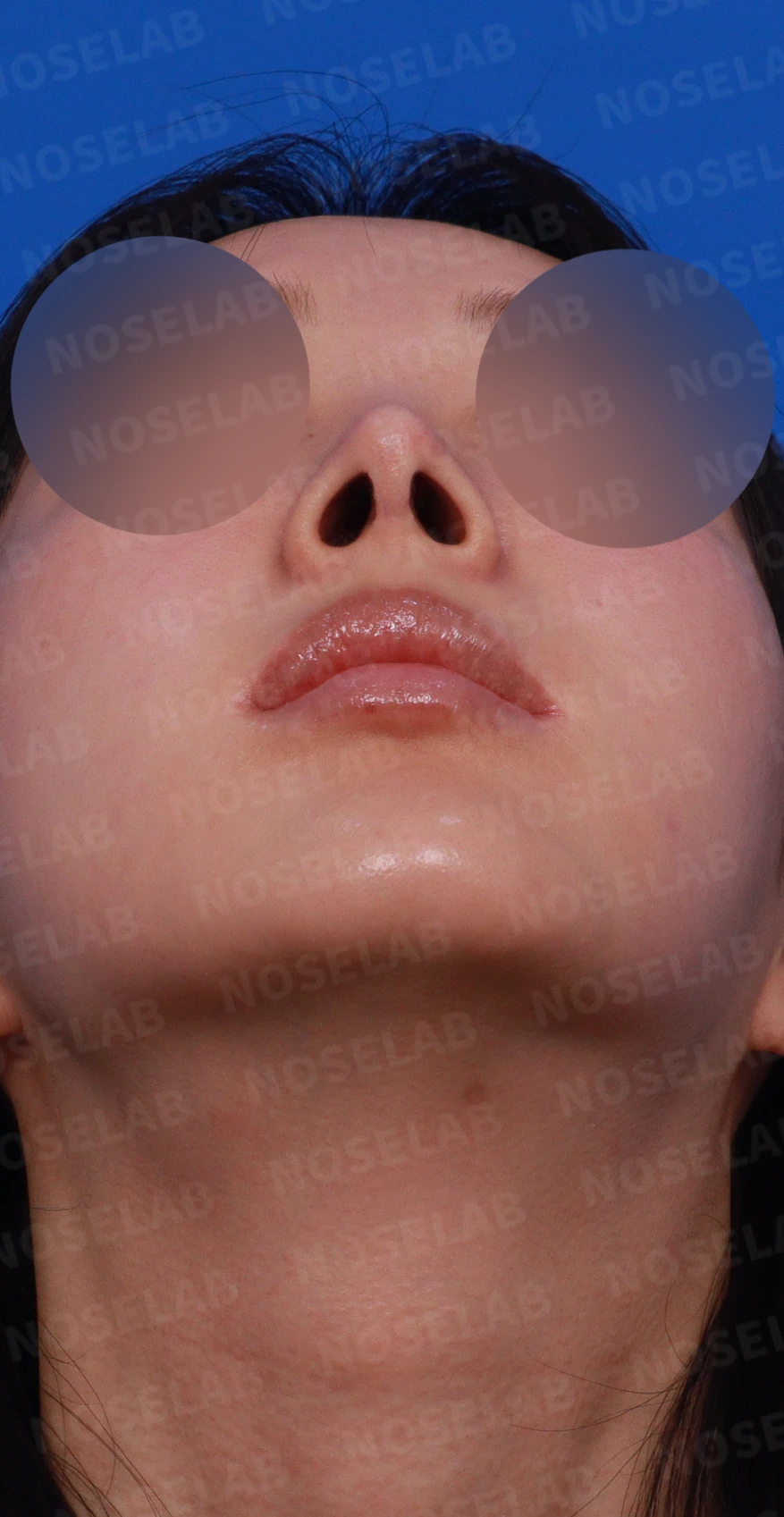뾰족한 코끝과 연골 비침 - 자가진피 코 재수술 후기 — 디자인 상담 우측 측면, 비스듬한 측면, 비공 사진