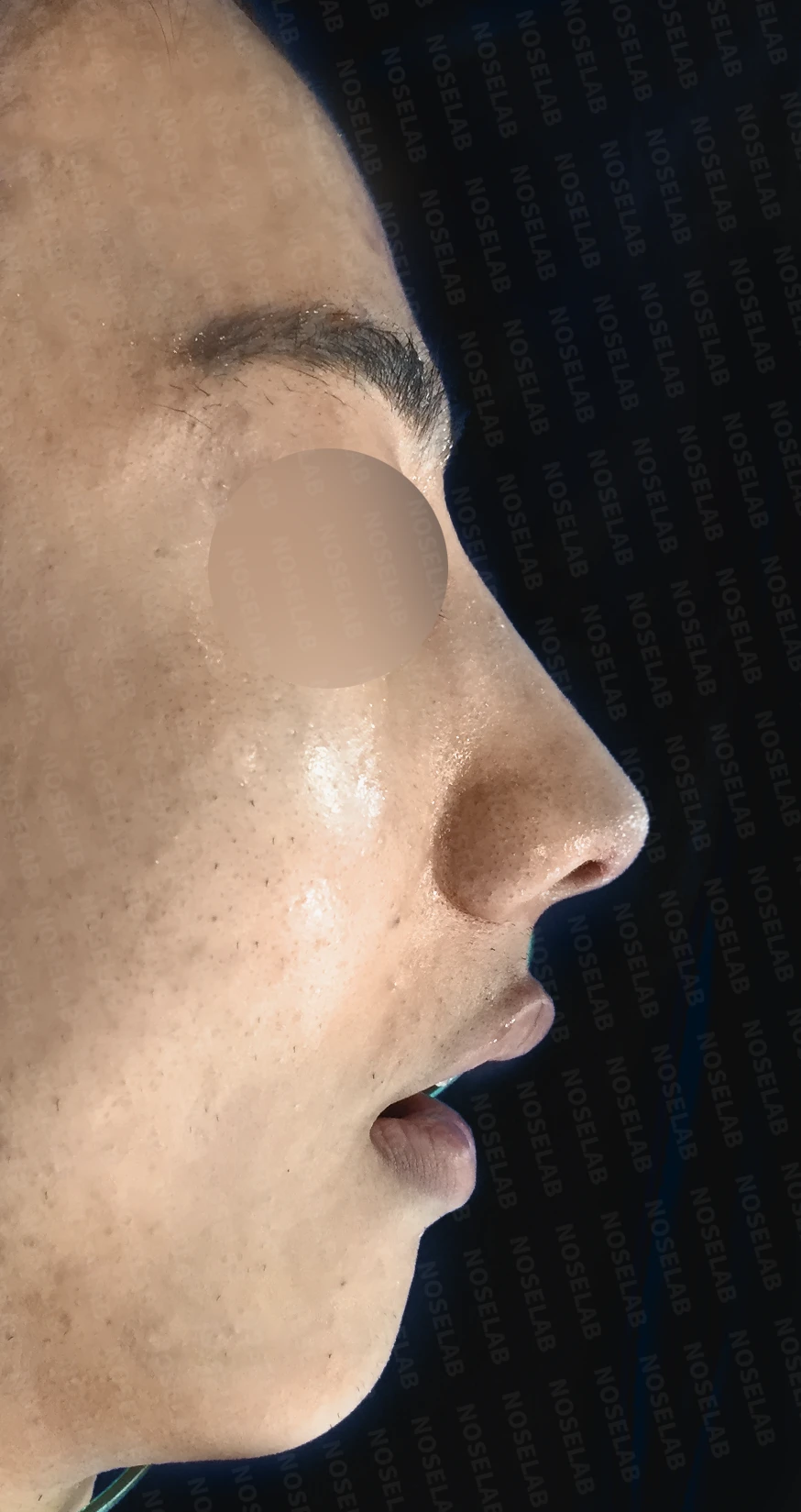 복코 교정과 비주 내리기를 함께 계획하는 방법 — 수술 직후 0일 정면, 측면, 비스듬한 측면 직후 사진은 부기가 있는 상태로 최종 결과와 다를 수 있습니다.