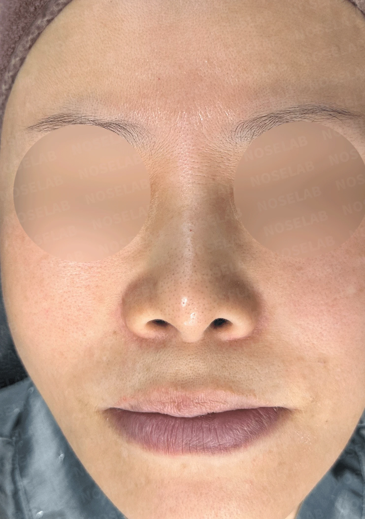 오래된 실리콘이 코끝에서 비쳐 보이는 이유와 제거·재건 방법 — 본문 사진 7