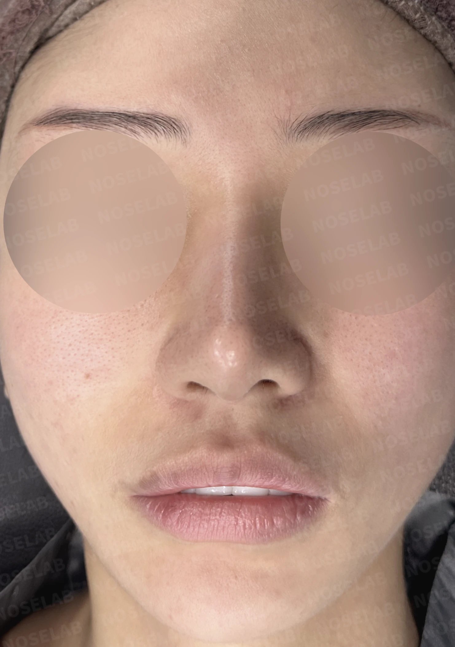 코끝 연골이 피부로 비쳐 보이는 이유와 진피 보강 방법 — 수술 전 / 수술 직후 0일 직후 사진은 부기가 있는 상태로 최종 결과와 다를 수 있습니다.