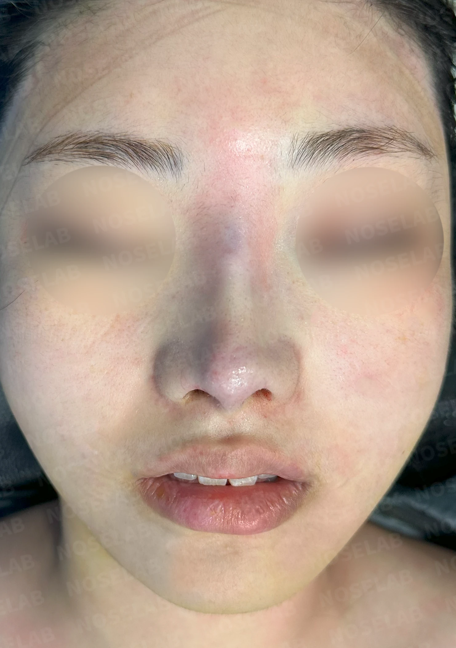 퍼진 코 개선과 콧구멍 비대칭 교정 방법 — 본문 사진 10