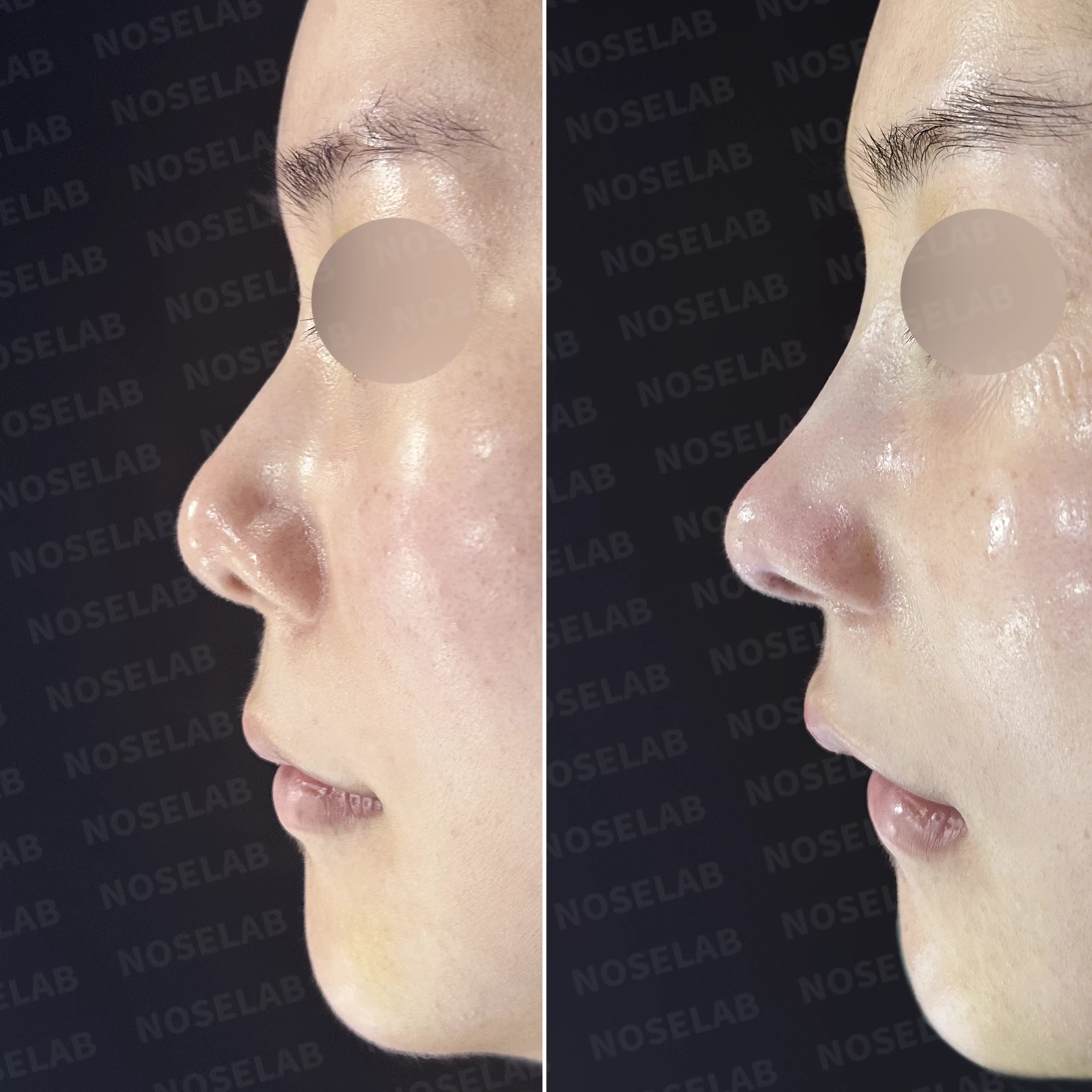 들린 코와 한쪽만 찝힌 콧구멍이 생기는 이유, 무보형물 재건은 어떻게 하나 — 본문 사진 20